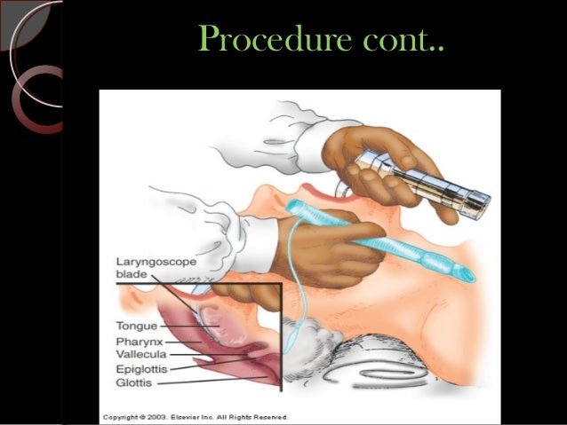 endotracheal intubation