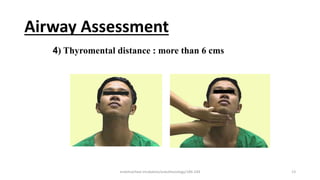 Airway Assessment
4) Thyromental distance : more than 6 cms
endotracheal intubation/anesthesiology/184-244 13
 
