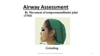 Airway Assessment
6) Movement of temperomandibular joint
(TMJ)
Grinding
endotracheal intubation/anesthesiology/184-244 15
 