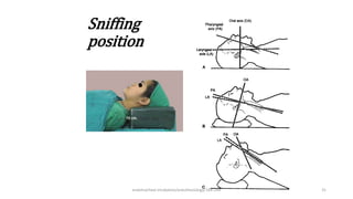 Sniffing
position
endotracheal intubation/anesthesiology/184-244 31
 