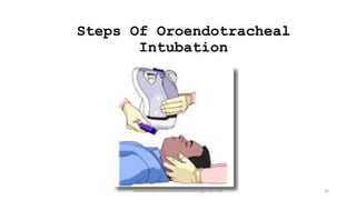 Steps Of Oroendotracheal
Intubation
endotracheal intubation/anesthesiology/184-244 32
 