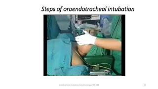Steps of oroendotracheal intubation
endotracheal intubation/anesthesiology/184-244 33
 