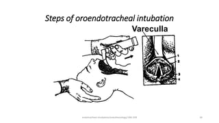Steps of oroendotracheal intubation
Vareculla
endotracheal intubation/anesthesiology/184-244 34
 