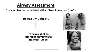 Airway Assessment
Enlarge thyroid gland
Trachea shift to
lateral or compressed
tracheal lumen
1) Condition that associated with difficult intubation (con’t)
endotracheal intubation/anesthesiology/184-244 8
 