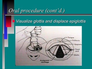 Oral procedure (cont’d.) Visualize glottis and displace epiglottis 