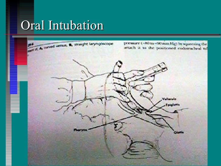 Endotracheal intubation extubation