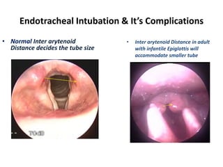 Endotracheal Intubation & It’s Complications
• Normal Inter arytenoid
Distance decides the tube size
• Inter arytenoid Distance in adult
with infantile Epiglottis will
accommodate smaller tube
 