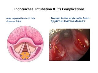 Endotracheal Intubation & It’s Complications
Inter arytenoid area ET Tube
Pressure Point
Trauma to the arytenoids heals
by fibrosis leads to Stenosis
 