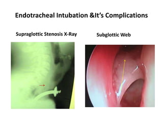 Endotracheal Intubation &It’s Complications
Supraglottic Stenosis X-Ray Subglottic Web
 