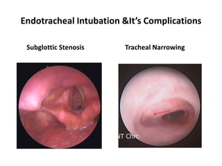 Endotracheal Intubation &It’s Complications
Subglottic Stenosis Tracheal Narrowing
 