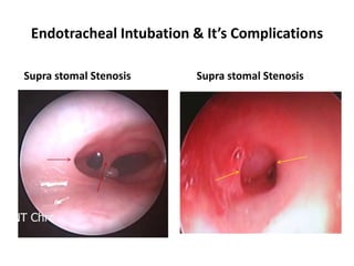 Endotracheal Intubation & It’s Complications
Supra stomal Stenosis Supra stomal Stenosis
 