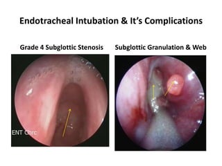 Endotracheal Intubation & It’s Complications
Grade 4 Subglottic Stenosis Subglottic Granulation & Web
 