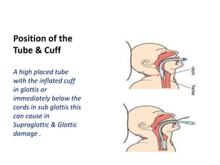 Position of the
Tube & Cuff
A high placed tube
with the inflated cuff
in glottis or
immediately below the
cords in sub glottis this
can cause in
Supraglottic & Glottic
damage .
 