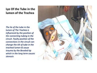 Lye Of the Tube in the
lumen of the Trachea
The lie of the tube in the
lumen of The Trachea is
influenced by the position of
the connecting tubing in the
circuit. Faulty position of the
connections in the circuit can
change the tilt of tube in the
tracheal lumen & cause
trauma by the Beveled tip
which in the long term causes
stenosis
 