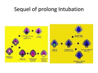 Sequel of prolong Intubation
 