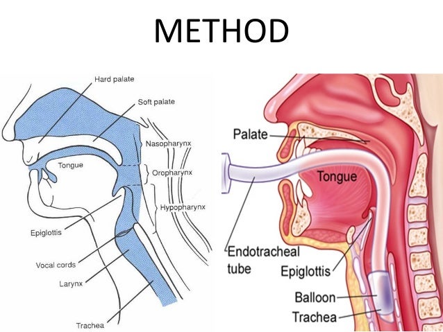 endotracheal tube