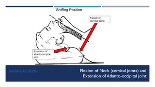SNIFFING POSITION Flexion of Neck (cervical joints) and
Extension of Atlanto-occipital joint
 