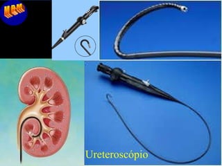 MBM Ureteroscópio 