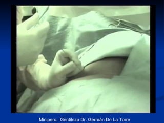 Miniperc:  Gentileza Dr. Germán De La Torre 
