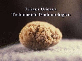 Litiasis Urinaria Tratamiento Endourologico 