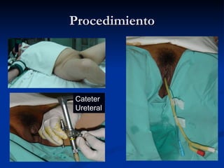 Procedimiento Cateter Ureteral 