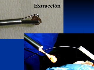 Extracción 