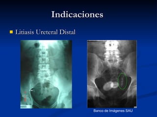 Indicaciones  <ul><li>Litiasis Ureteral Distal </li></ul>Banco de Imágenes SAU 