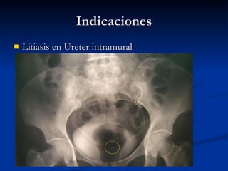 Indicaciones <ul><li>Litiasis en Ureter intramural </li></ul>