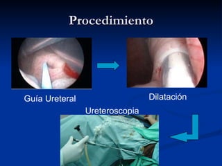 Procedimiento Guía Ureteral Dilatación Ureteroscopia 