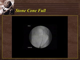 Stone Cone Full 