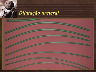 Dilatação ureteral 