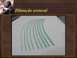 Dilatação ureteral 