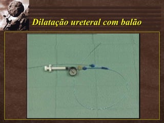 Dilatação ureteral com balão 