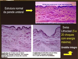 Estrutura normal da parede ureteral Swiss Lithoclast  (5 e 20 choques com energia máxima).   Urotélio íntegro 