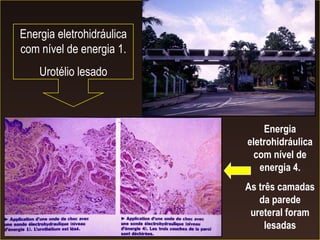 Energia eletrohidráulica com nível de energia 1. Urotélio lesado Energia eletrohidráulica com nível de energia 4. As três camadas da parede ureteral foram lesadas 