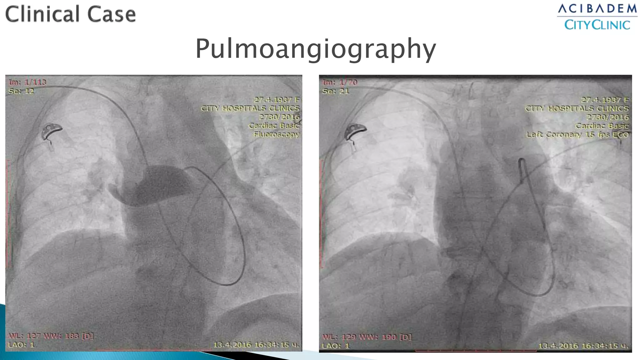 Endovascular and surgical treatment of pulmonary embolism 26.11.17
