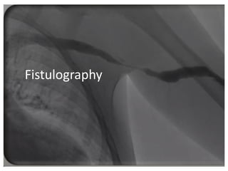 Fistulography
 