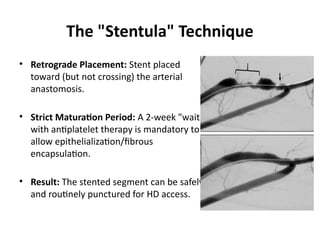 The "Stentula" Technique
• Retrograde Placement: Stent placed
toward (but not crossing) the arterial
anastomosis.
• Strict Maturation Period: A 2-week "wait"
with antiplatelet therapy is mandatory to
allow epithelialization/fibrous
encapsulation.
• Result: The stented segment can be safely
and routinely punctured for HD access.
 