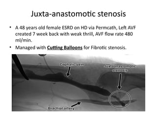 Juxta-anastomotic stenosis
• A 48 years old female ESRD on HD via Permcath, Left AVF
created 7 week back with weak thrill, AVF flow rate 480
ml/min.
• Managed with Cutting Balloons for Fibrotic stenosis.
 