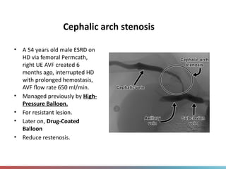 Cephalic arch stenosis
• A 54 years old male ESRD on
HD via femoral Permcath,
right UE AVF created 6
months ago, interrupted HD
with prolonged hemostasis,
AVF flow rate 650 ml/min.
• Managed previously by High-
Pressure Balloon.
• For resistant lesion.
• Later on, Drug-Coated
Balloon
• Reduce restenosis.
 