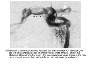 Endovascular management of carotid cavernous fistula | PPT