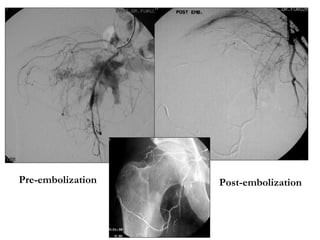 Endovascular management of complex vascular malformations | PPT