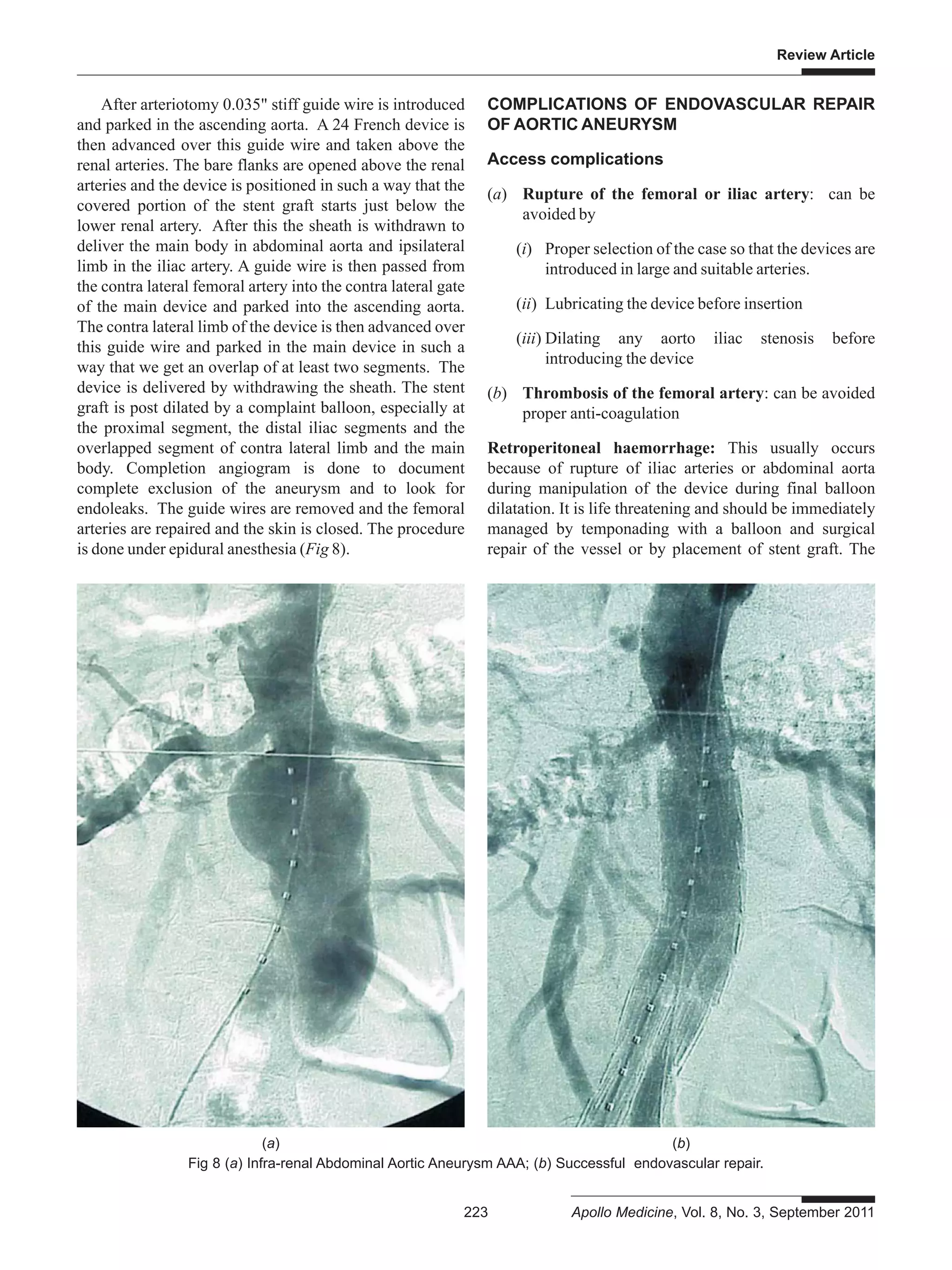 Endovascular repair of thoracic and abdominal aortic aneurysms | PDF