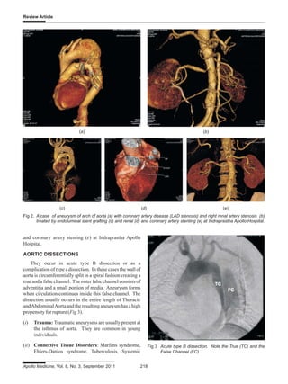 Endovascular repair of thoracic and abdominal aortic aneurysms | PDF