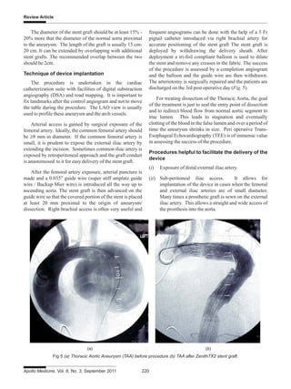 Review Article
Apollo Medicine, Vol. 8, No. 3, September 2011 220
The diameter of the stent graft should be at least 15% -
20% more that the diameter of the normal aorta proximal
to the aneurysm. The length of the graft is usually 15 cm-
20 cm. It can be extended by overlapping with additional
stent grafts. The recommended overlap between the two
should be 2cm.
Technique of device implantation
The procedure is undertaken in the cardiac
catheterization suite with facilities of digital substraction
angiography (DSA) and road mapping. It is important to
fix landmarks after the control angiogram and not to move
the table during the procedure. The LAO view is usually
used to profile these aneurysm and the arch vessels.
Arterial access is gained by surgical exposure of the
femoral artery. Ideally, the common femoral artery should
be ≥8 mm in diameter. If the common femoral artery is
small, it is prudent to expose the external iliac artery by
extending the incision. Sometimes common iliac artery is
exposed by retroperitoneal approach and the graft conduit
is anastomosed to it for easy delivery of the stent graft.
After the femoral artery exposure, arterial puncture is
made and a 0.035" guide wire (super stiff amplatz guide
wire / Backup Mier wire) is introduced all the way up to
ascending aorta. The stent graft is then advanced on the
guide wire so that the covered portion of the stent is placed
at least 20 mm proximal to the origin of aneurysm/
dissection. Right brachial access is often very useful and
frequent angiograms can be done with the help of a 5 Fr
pigtail catheter introduced via right brachial artery for
accurate positioning of the stent graft The stent graft is
deployed by withdrawing the delivery sheath. After
deployment a tri-foil compliant balloon is used to dilate
the stent and remove any creases in the fabric. The success
of the procedure is assessed by a completion angiogram
and the balloon and the guide wire are then withdrawn.
The arteriotomy is surgically repaired and the patients are
discharged on the 3rd post operative day (Fig. 5).
For treating dissection of the Thoracic Aorta, the goal
of the treatment is just to seal the entry point of dissection
and to redirect blood flow from normal aortic segment to
true lumen. This leads to stagnation and eventually
clotting of the blood in the false lumen and over a period of
time the aneurysm shrinks in size. Peri operative Trans-
Esophageal Echocardiography (TEE) is of immense value
in assessing the success of the procedure.
Procedures helpful to facilitate the delivery of the
device
(i) Exposure of distal external iliac artery.
(ii) Sub-peritoneal iliac access. It allows for
implantation of the device in cases when the femoral
and external iliac arteries are of small diameter.
Many times a prosthetic graft is sewn on the external
iliac artery. This allows a straight and wide access of
the prosthesis into the aorta.
Fig 5 (a) Thoracic Aortic Aneurysm (TAA) before procedure (b) TAA after ZenithTX2 stent graft.
(a) (b)
 
