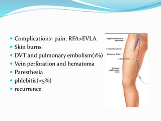 Complications- pain. RFA>EVLA
 Skin burns
 DVT and pulmonary embolism(1%)
 Vein perforation and hematoma
 Paresthesia
 phlebitis(<5%)
 recurrence
 