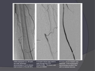 Initial angiogram in a 64-year-    A Crosser device was used to     A 6 mm x 15 cm Viabahn was
old male claudicant                pass through the CTO             deployed. Final angiography
demonstrates a 12-cm chronic       intraluminally. The lesion was   demonstrates excellent flow
total occlusion of the left SFA.   then pre-dilated.                with no residual stenosis.
 