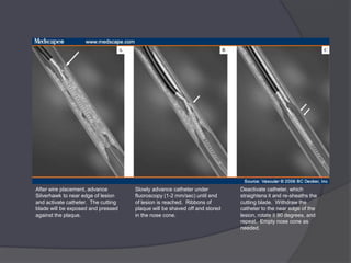 After wire placement, advance        Slowly advance catheter under          Deactivate catheter, which
Silverhawk to near edge of lesion    fluoroscopy (1-2 mm/sec) until end     straightens it and re-sheaths the
and activate catheter. The cutting   of lesion is reached. Ribbons of       cutting blade. Withdraw the
blade will be exposed and pressed    plaque will be shaved off and stored   catheter to the near edge of the
against the plaque.                  in the nose cone.                      lesion, rotate it 90 degrees, and
                                                                            repeat. Empty nose cone as
                                                                            needed.
 
