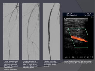 Diffuse, severe in-stent   Following 4 passes of      Following adjunctive       Doppler ultrasound 6 months later demonstrates
restenosis 1 year after    TURBO-Booster excimer      cryoplasty, an excellent   continued patency. The patient is asymptomatic.
placement of a Nitinol     laser, the lumen is much   angiographic result is
SFA stent. The patient     improved. Mild stenosis/   achieved.
presented with             irregularity remains.
recurrent claudication.
 