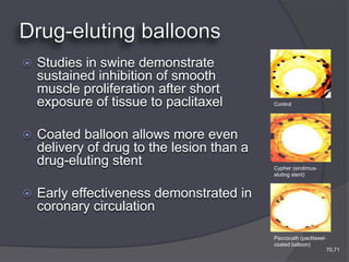    Studies in swine demonstrate
    sustained inhibition of smooth
    muscle proliferation after short
    exposure of tissue to paclitaxel        Control




   Coated balloon allows more even
    delivery of drug to the lesion than a
    drug-eluting stent                      Cypher (sirolimus-
                                            eluting stent)


   Early effectiveness demonstrated in
    coronary circulation

                                            Paccocath (paclitaxel-
                                            coated balloon)
                                                                     70,71
 